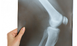 Рентгенография локтевого сустава( 2 проекции)